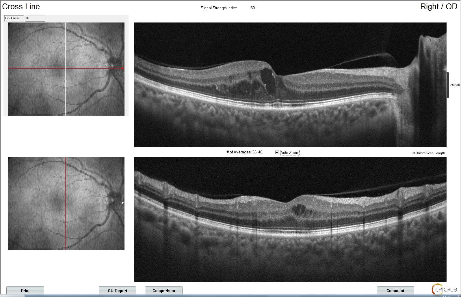 Edema macular diabético visualizado em exame de OCT.